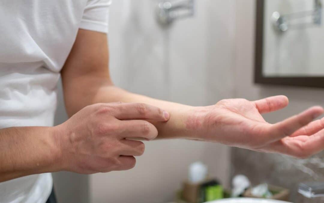 Chemical Burns: What Are They, and Can Victims Get Compensated?