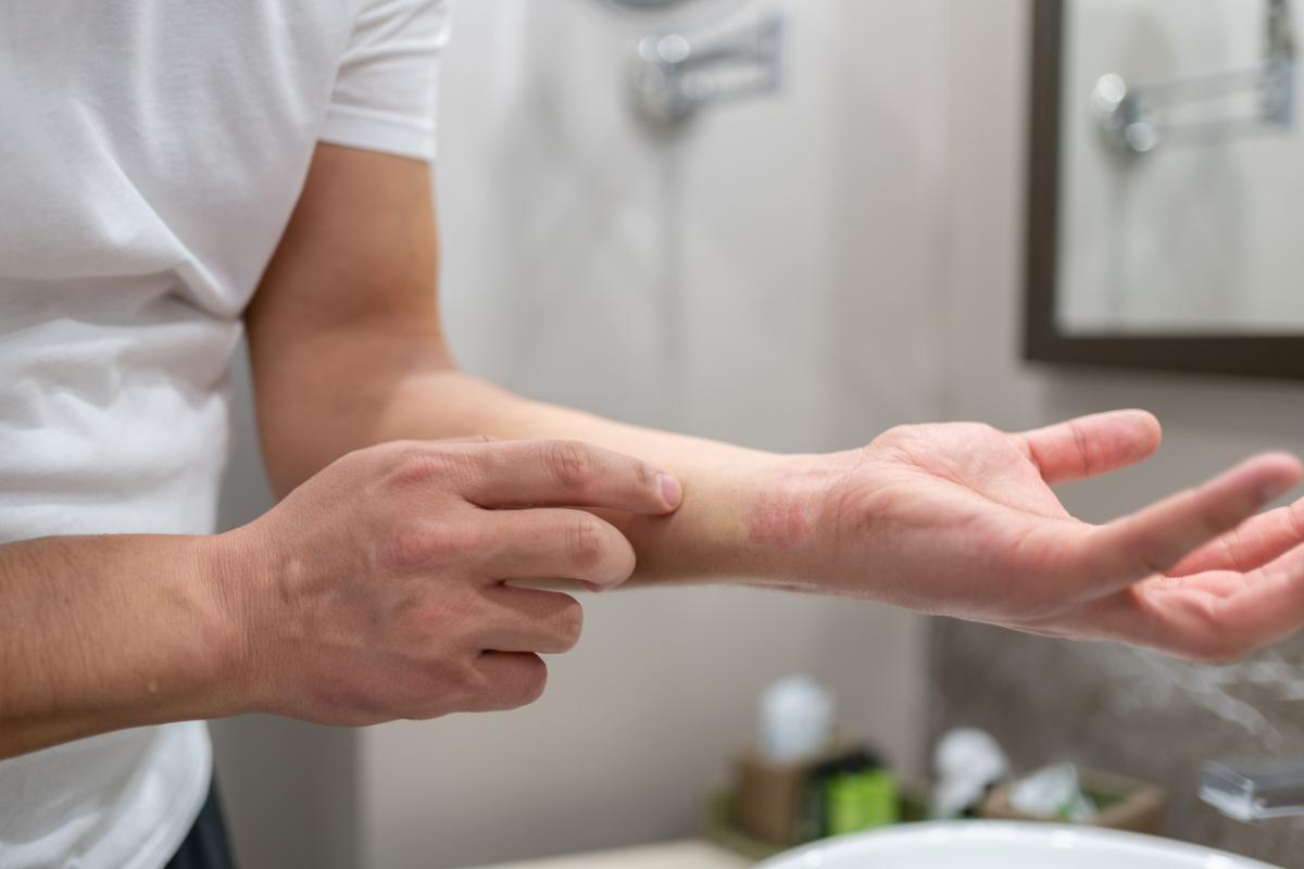 Chemical Burns: What Are They, and Can Victims Get Compensated?