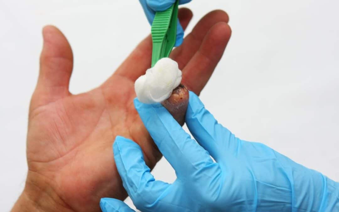 Finger Amputation from an Accident? Seek Legal Help Now