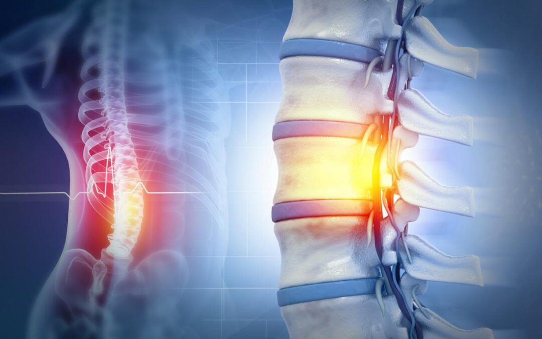 Can I Get Compensation in Texas for a Spinal Cord Injury?