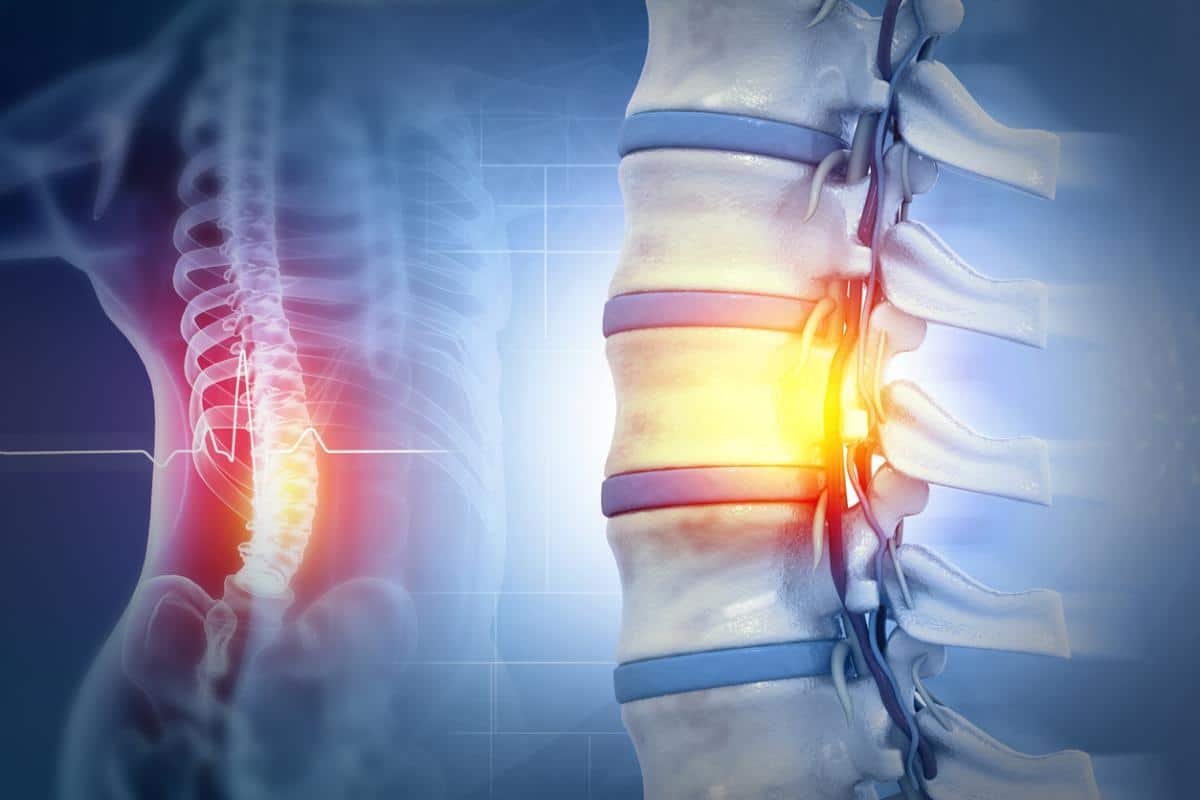 Can I Get Compensation in Texas for a Spinal Cord Injury?